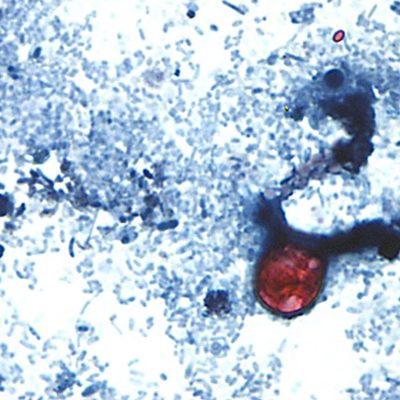 Two die as cases of ‘explosive diarrhoea’ infection surge in US state